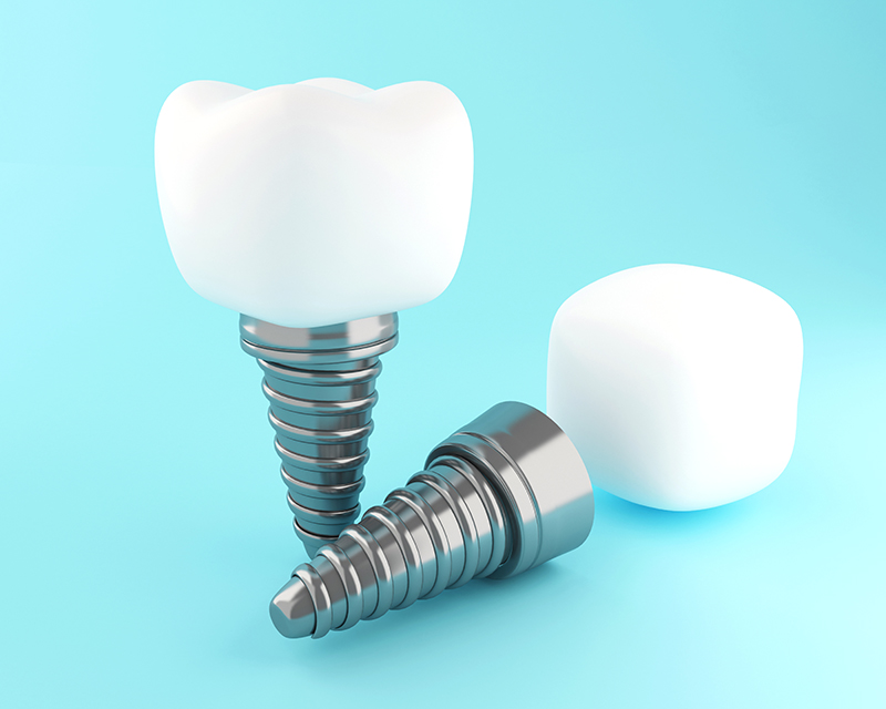 What is a Dental Implant?
