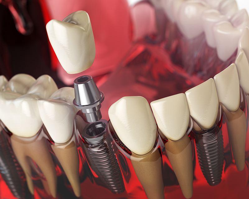 What is a Dental Implant?