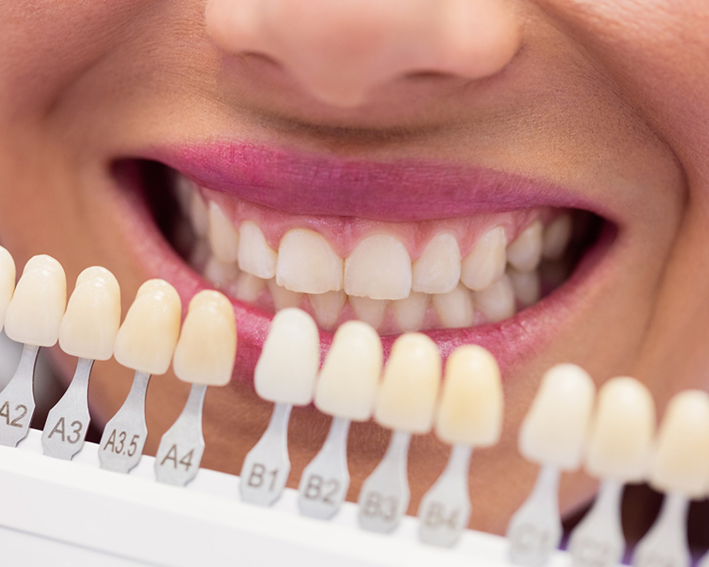 What are Digital Veneers ?